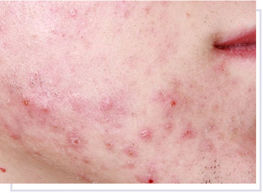 Acne: sintomi, cause, tutti i rimedi