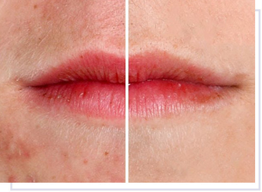 Curare l’acne con metodi naturali