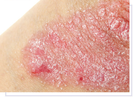 La psoriasi: cause, sintomi e cure